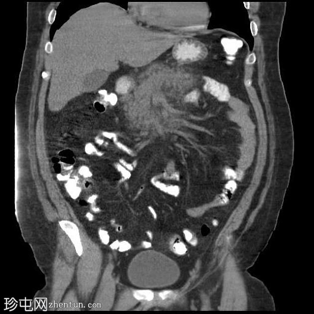 急性胰腺炎