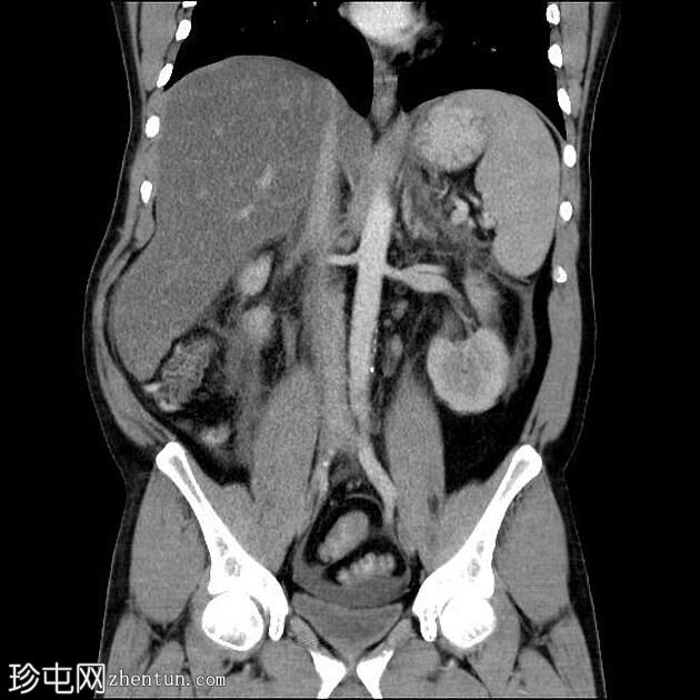 急性胰腺炎