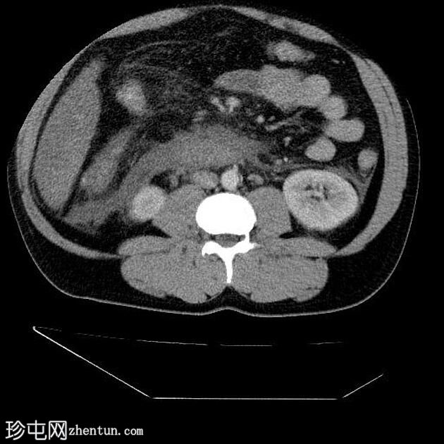 急性胰腺炎