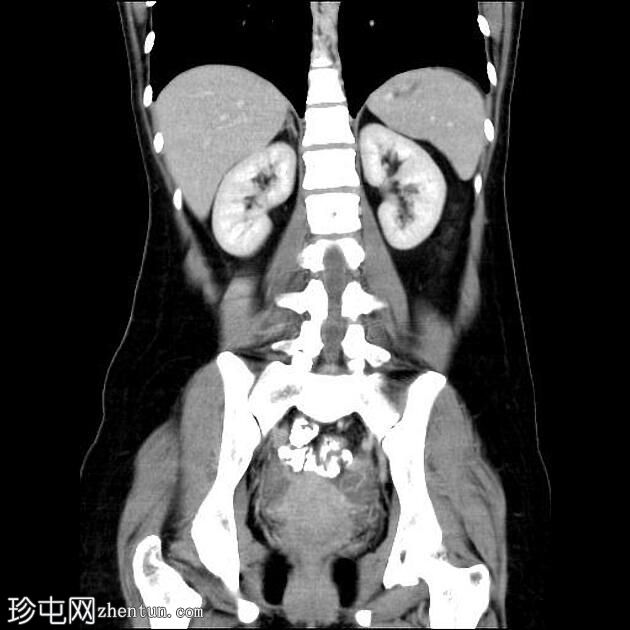 急性阑尾炎