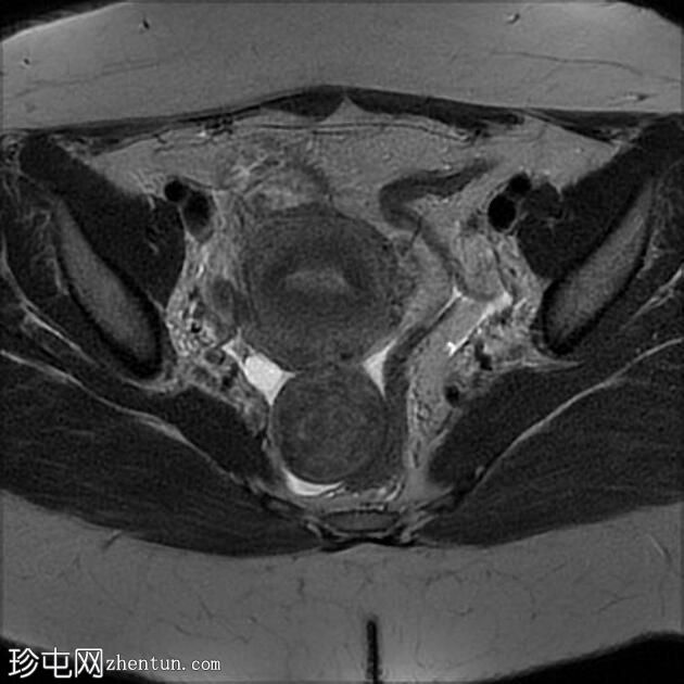 子宫浆膜下平滑肌瘤脱出直肠子宫陷凹