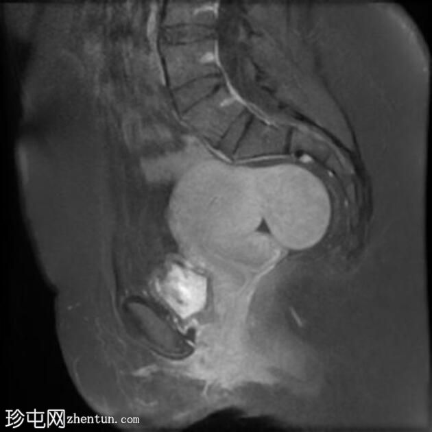 子宫浆膜下平滑肌瘤脱出直肠子宫陷凹