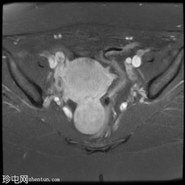 子宫浆膜下平滑肌瘤脱出直肠子宫陷凹