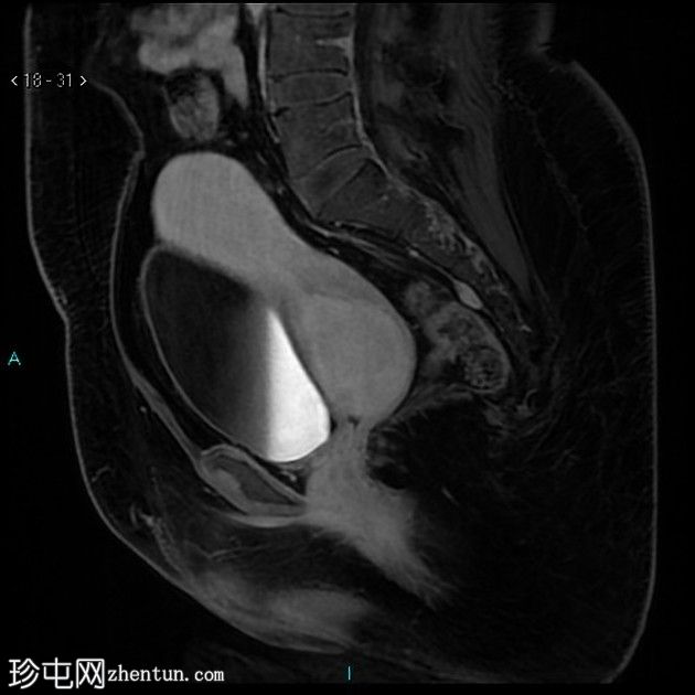 子宫黏膜下肌瘤脱垂