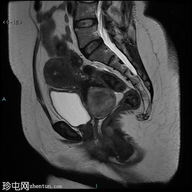 子宫黏膜下肌瘤脱垂