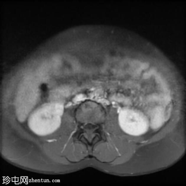 多个子宫平滑肌瘤