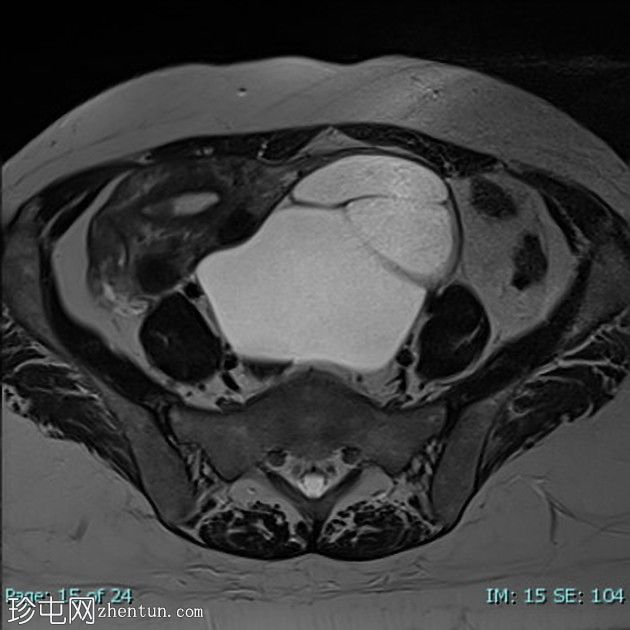 卵巢浆液性囊腺瘤