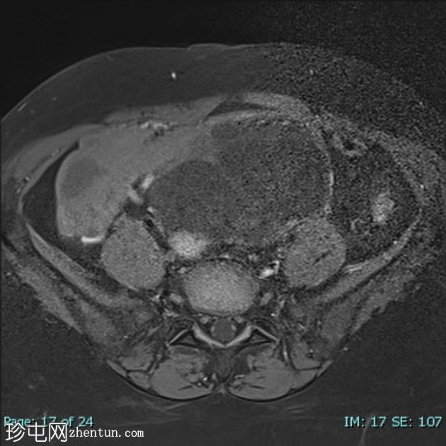 卵巢浆液性囊腺瘤