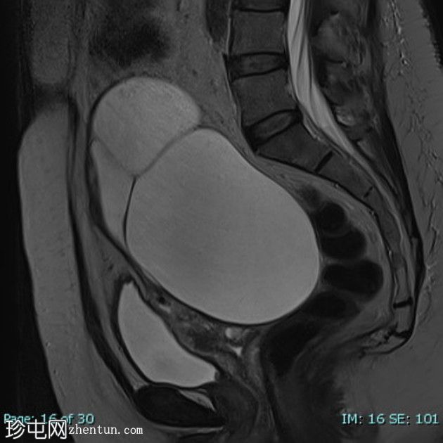 卵巢浆液性囊腺瘤