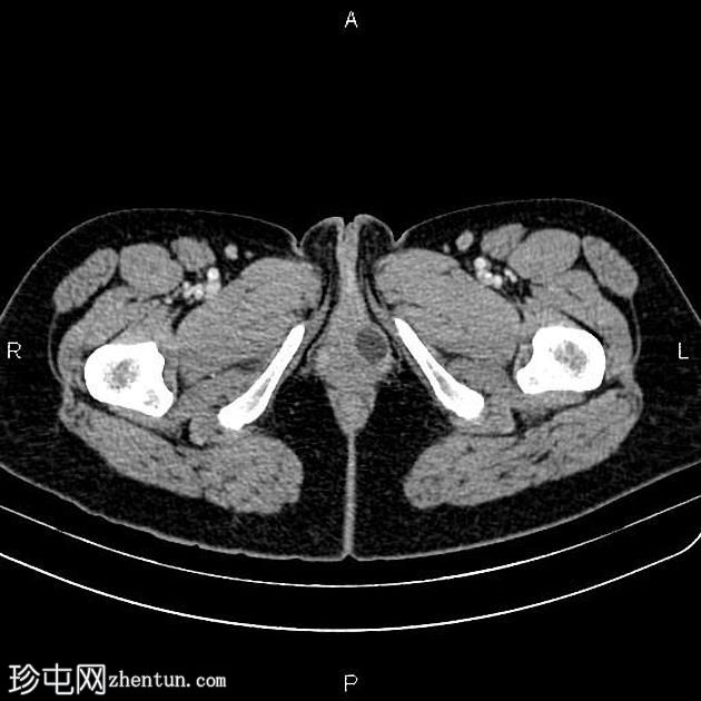 前庭大腺囊肿