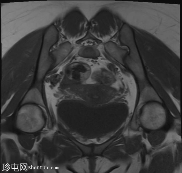 成熟卵巢囊性畸胎瘤