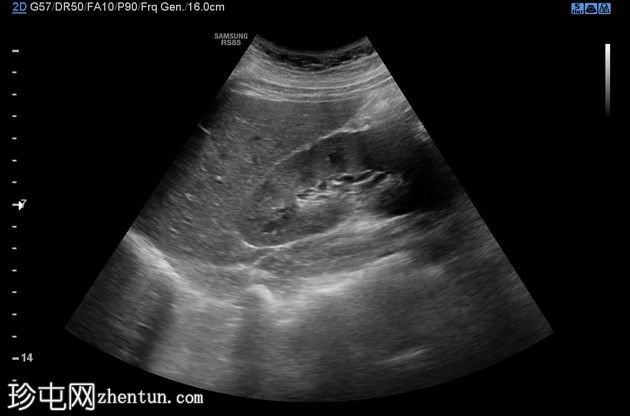 输卵管异位妊娠