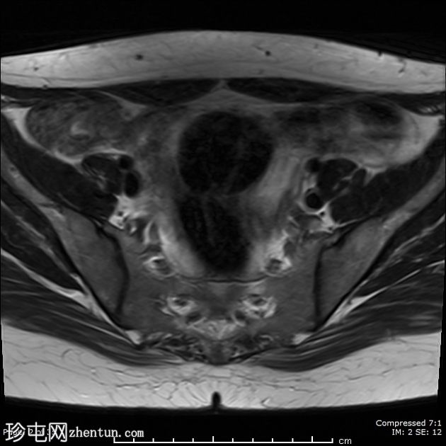 Mayer-Rokitansky-Küster-Hauser综合征伴持续性降结肠系膜