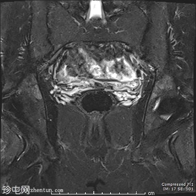 Mayer-Rokitansky-Küster-Hauser综合征伴持续性降结肠系膜