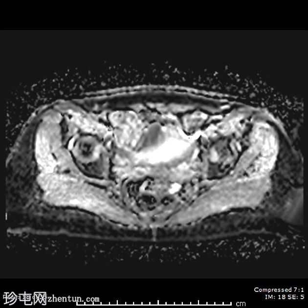 Mayer-Rokitansky-Küster-Hauser综合征伴持续性降结肠系膜