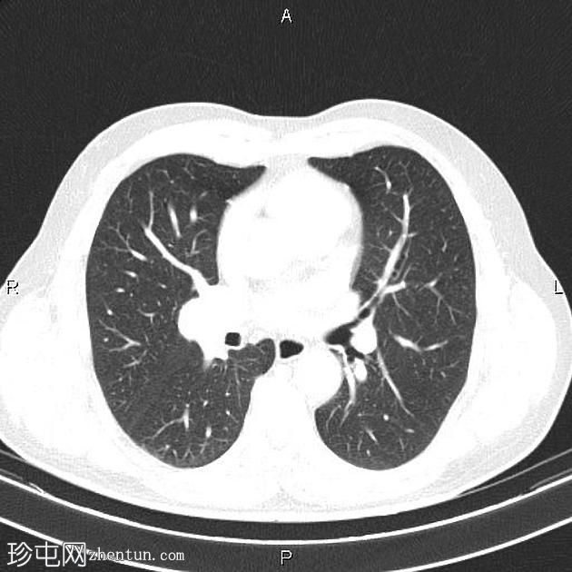 转移性肾细胞癌伴膀胱移行细胞癌