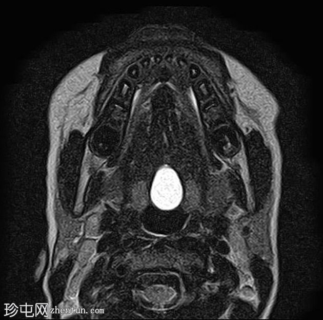 舌甲状腺舌管囊肿