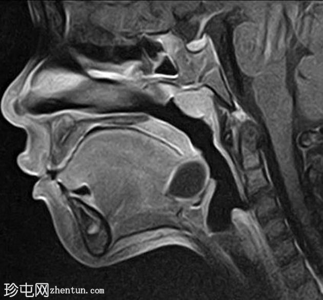 舌甲状腺舌管囊肿