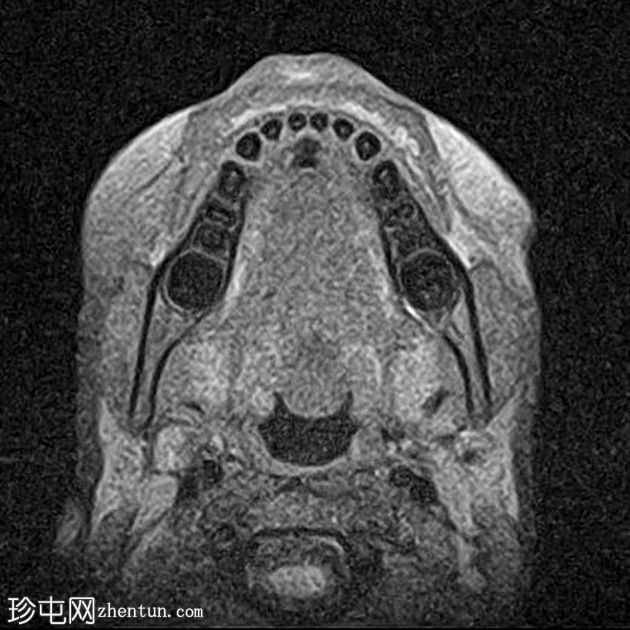 舌甲状腺舌管囊肿