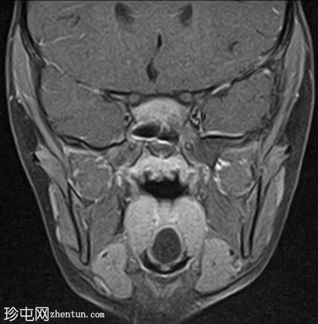 舌甲状腺舌管囊肿