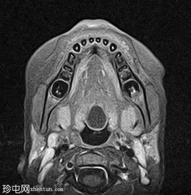 舌甲状腺舌管囊肿