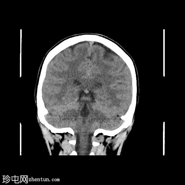 急性中耳炎