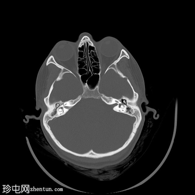 急性中耳炎