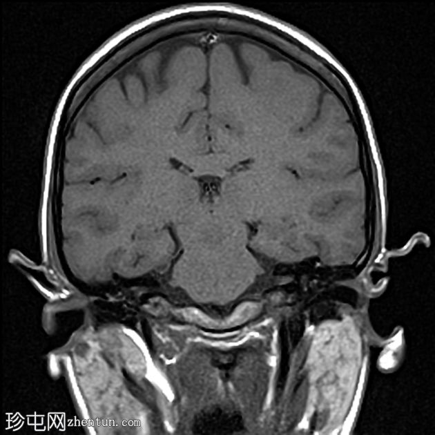 急性中耳炎