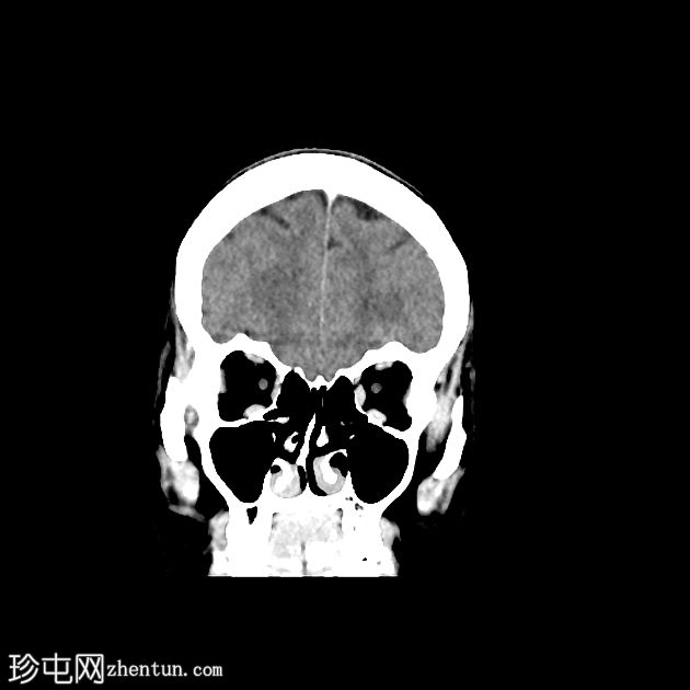 急性中耳炎