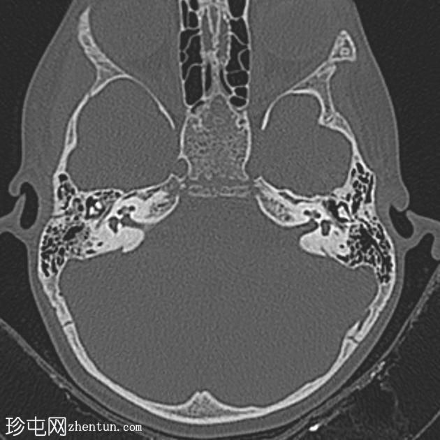 颞骨纵向骨折伴踝骨脱位