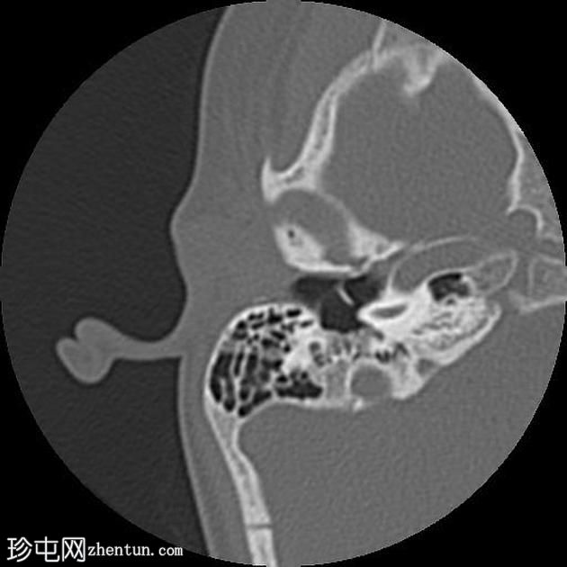 颞骨纵向骨折伴踝骨脱位