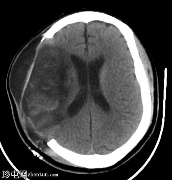 右MCA梗死和去骨瓣切除术