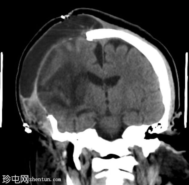 右MCA梗死和去骨瓣切除术