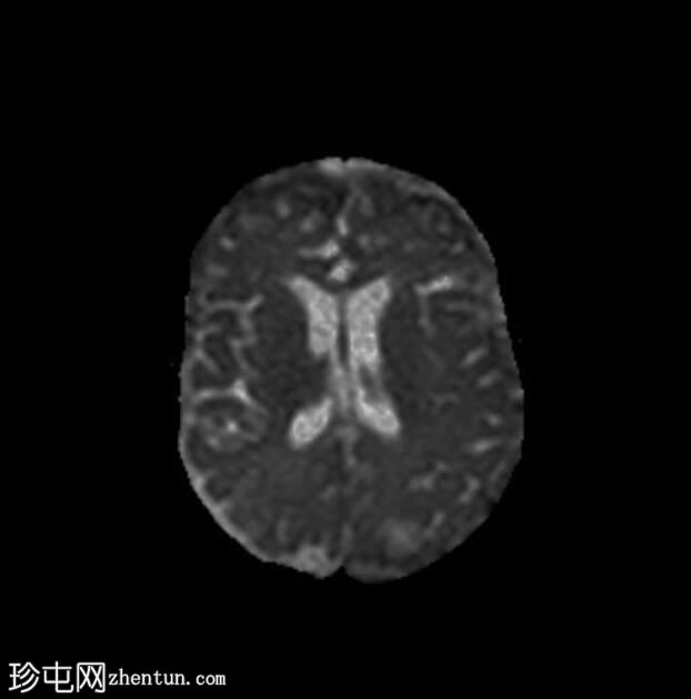 细菌性脑膜炎-蛛网膜下腔分隔