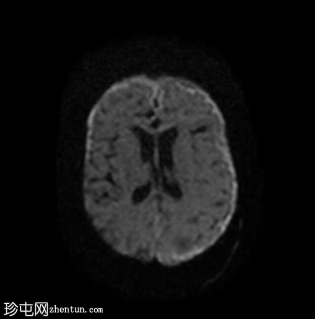 细菌性脑膜炎-蛛网膜下腔分隔