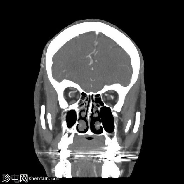 双动静脉瘘- Cognard IV型