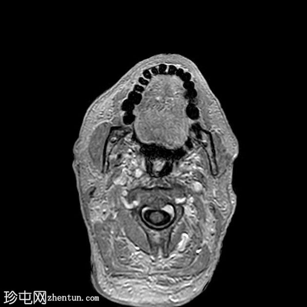 双动静脉瘘- Cognard IV型