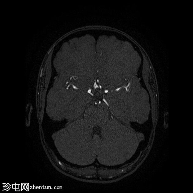 大脑前动脉开窗