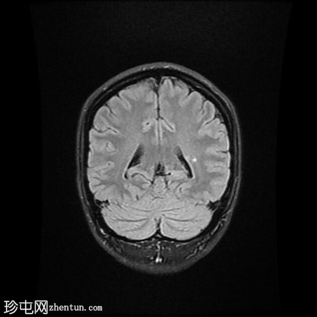 大脑前动脉开窗