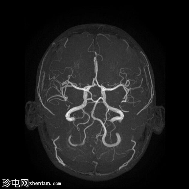 大脑前动脉开窗