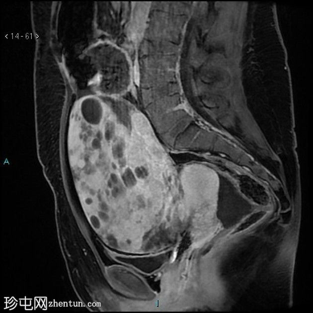 转移性神经内分泌肿瘤