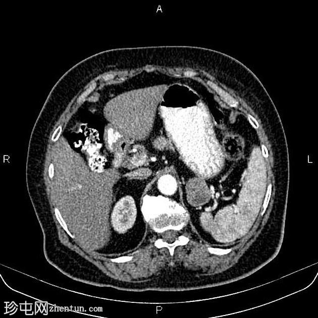 胃间质瘤，类似肾上腺转移