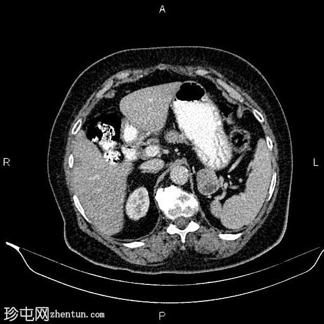 胃间质瘤，类似肾上腺转移