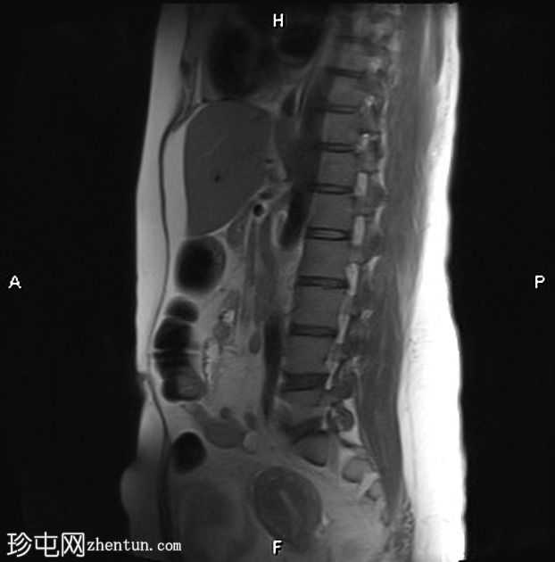 腹直肌分离