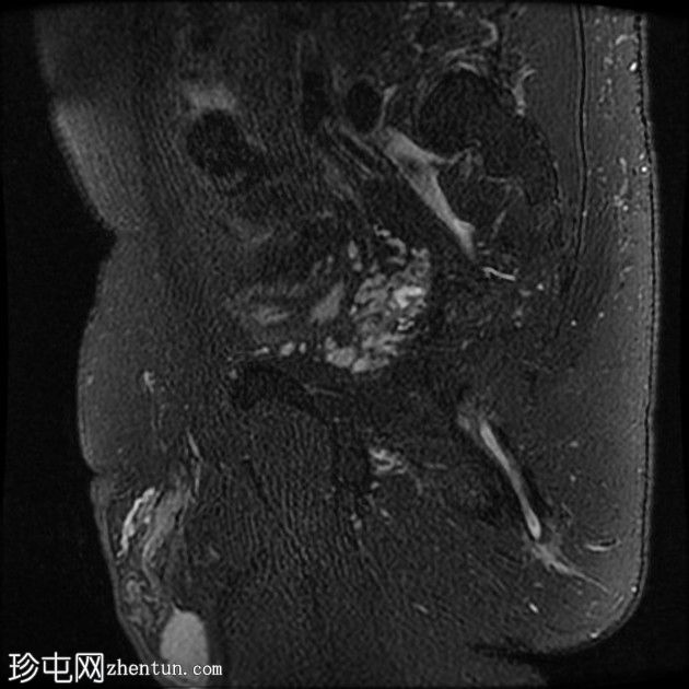 括约肌上肛瘘