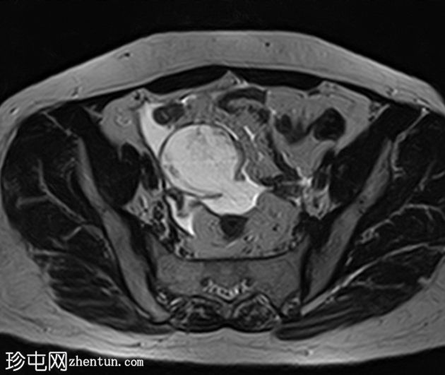 阑尾黏液囊肿破裂伴腹膜假黏液瘤