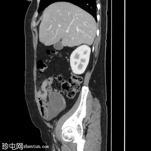 阑尾黏液囊肿破裂伴腹膜假黏液瘤