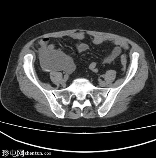 阑尾黏液囊肿破裂伴腹膜假黏液瘤