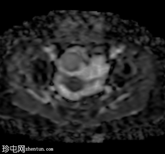 阑尾黏液囊肿破裂伴腹膜假黏液瘤