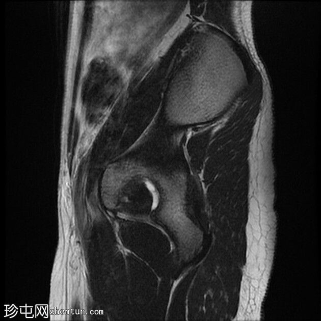 双子宫伴阴道纵隔